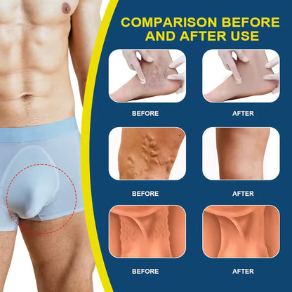 🔥HOT SALE 50% OFF🔥Varicocele Ointment